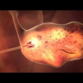 3D animation of how IVF works